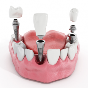 cheap dental implants overseas