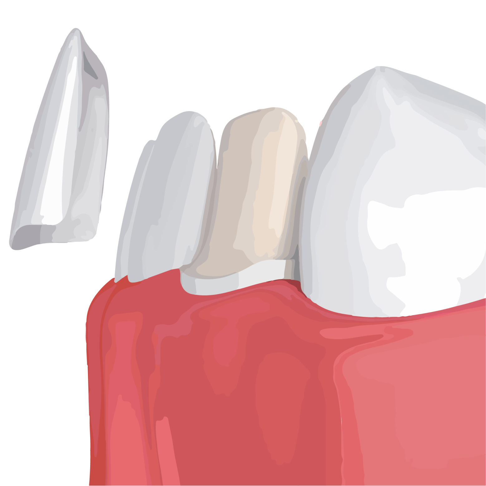 illustration of dental veneers being placed