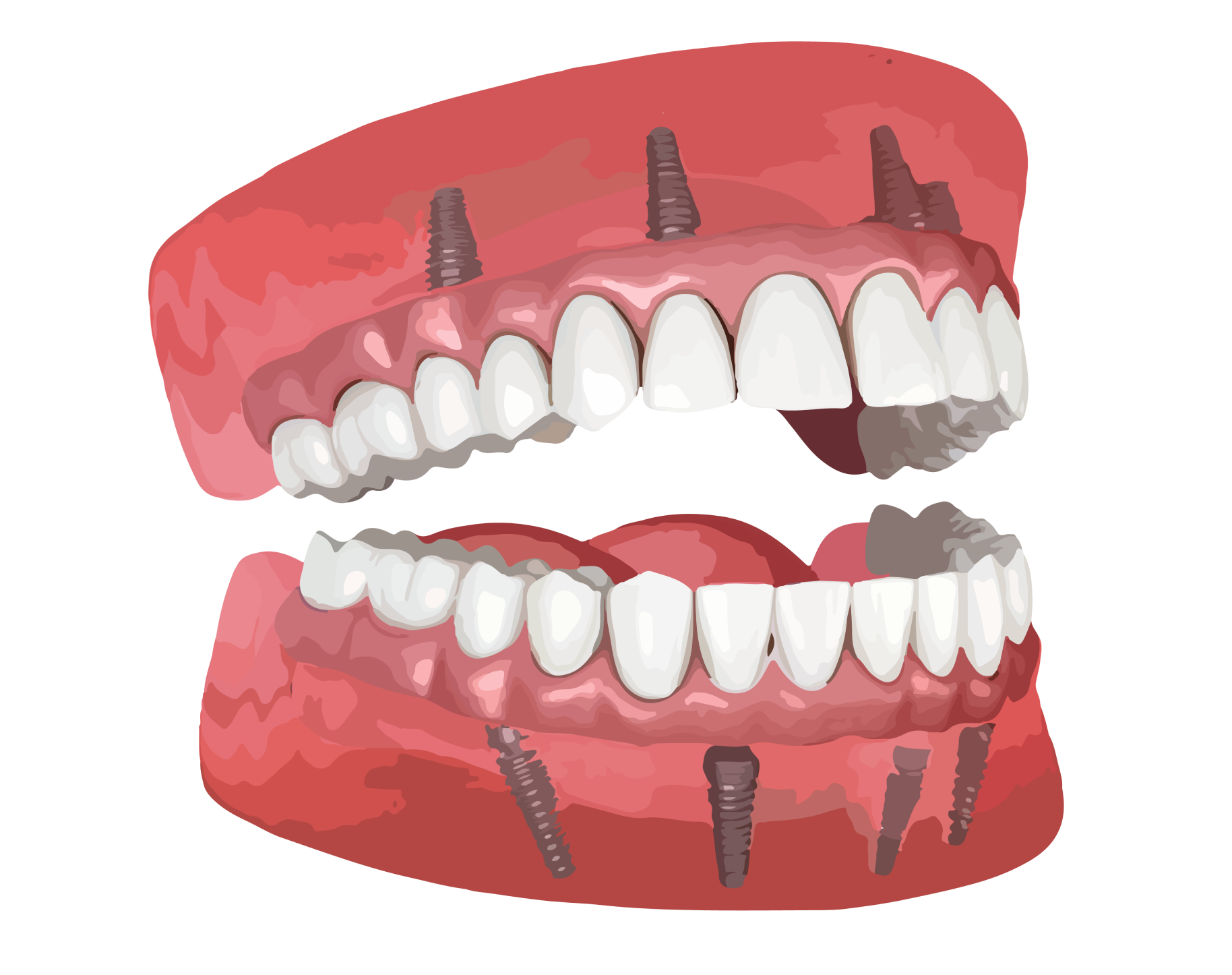 illustration of all-on-4 teeth implants abroad