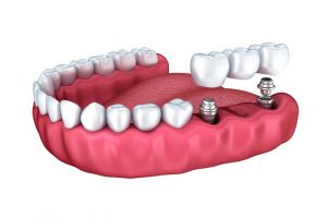 full set of dental implants abroad